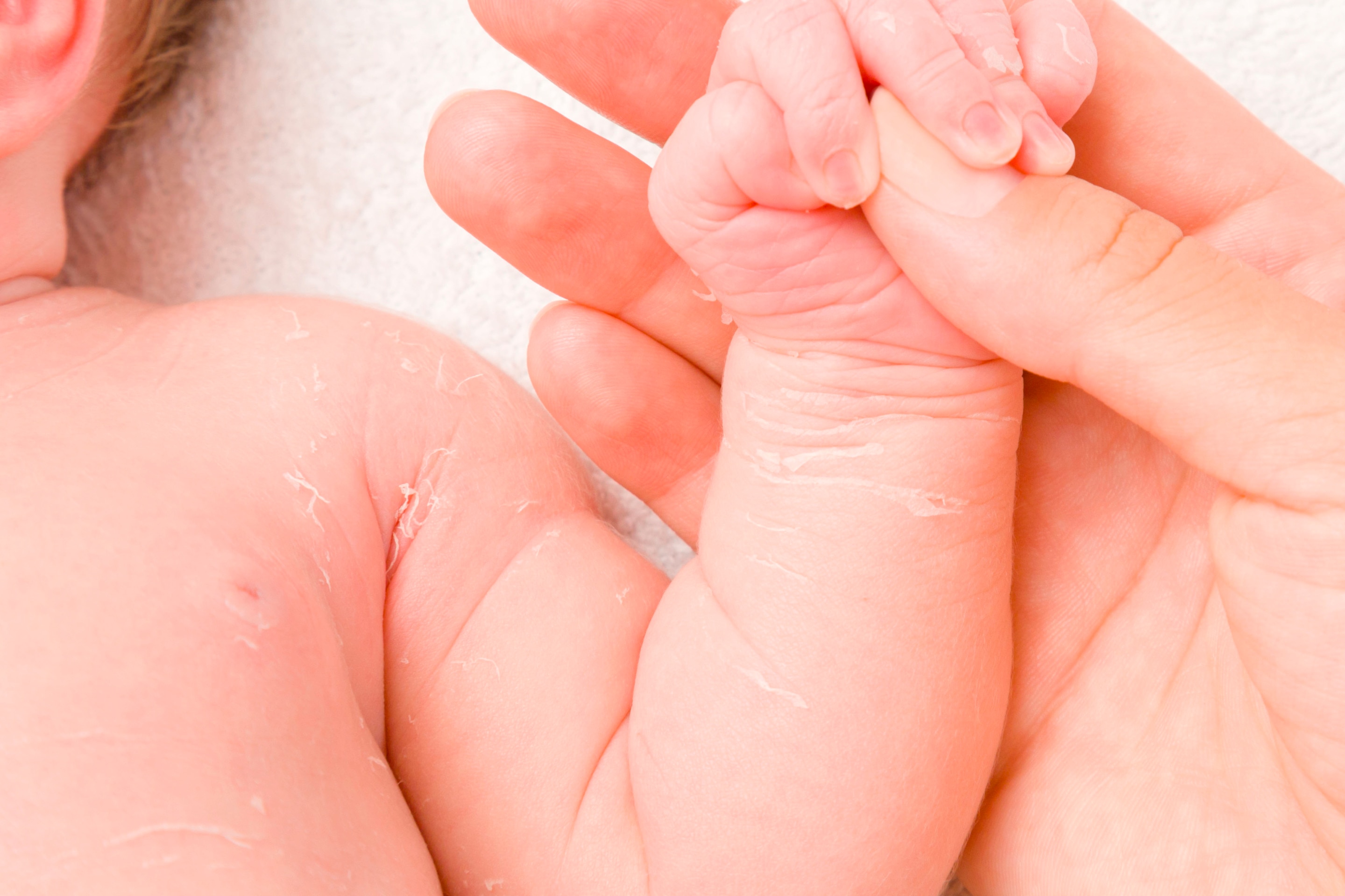 Bayi yang kulitnya tengah mengelupas