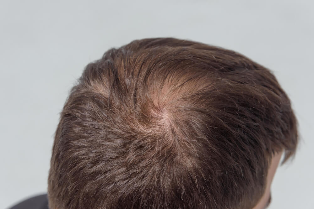 【ヘアメイク監修】薄毛の個性を生かして！おしゃれな坊主にチャレンジ