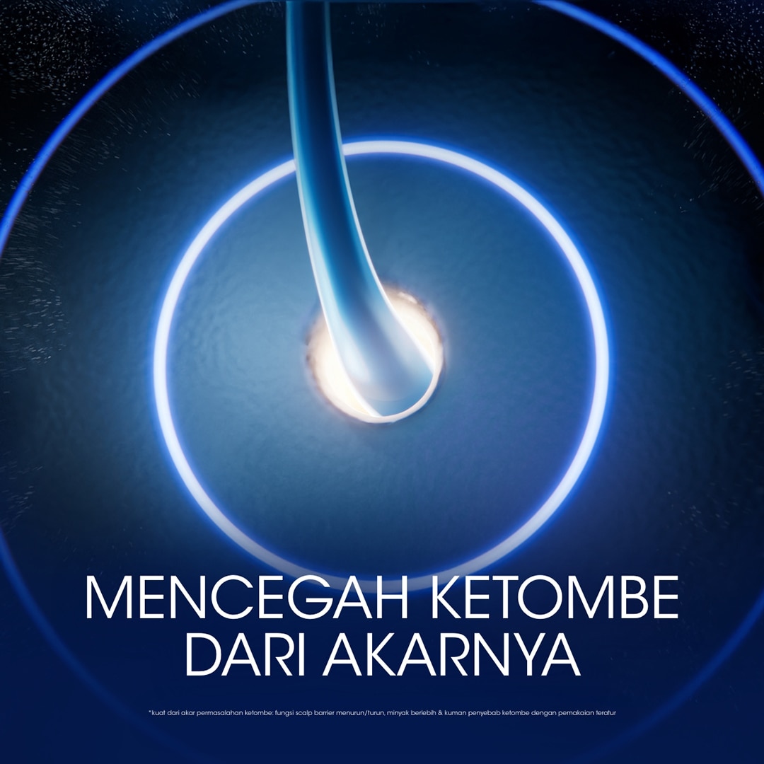 mencegah ketombe datang lagi