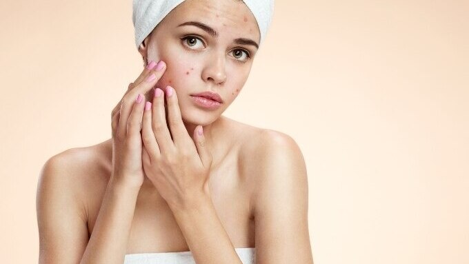 FAQs about Pimple Removal