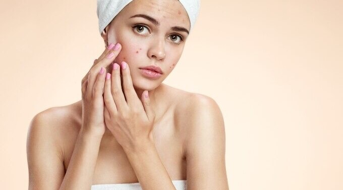 FAQs about Pimple Removal