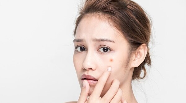 5 Things That Are Responsible For Delaying Your Acne Scars Healing Process