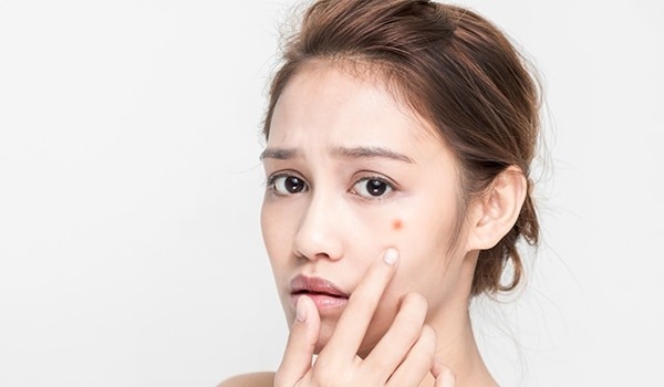 5 Things That Are Responsible For Delaying Your Acne Scars Healing Process