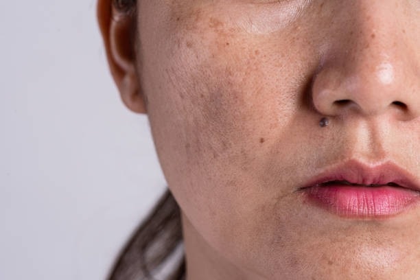Home Remedies ForPigmentation