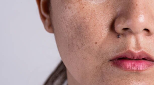 Home Remedies ForPigmentation