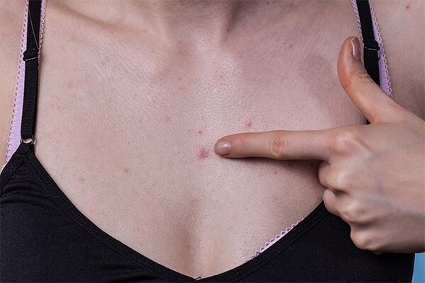 Best practices to help deal with chest acne