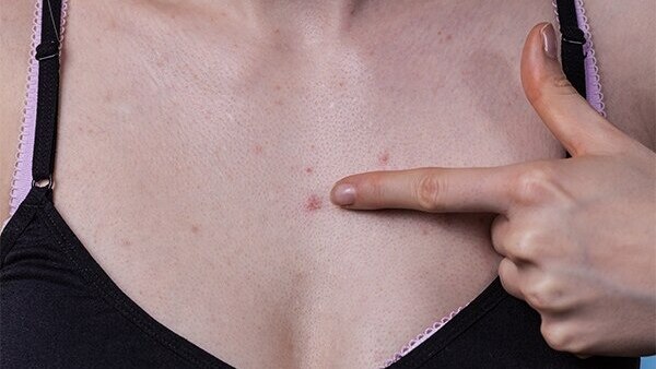 Best practices to help deal with chest acne
