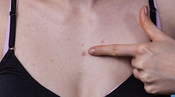 Best practices to help deal with chest acne