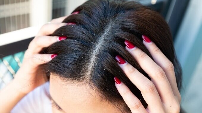 dandruff treatment faqs