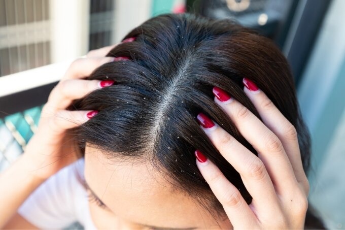 dandruff treatment faqs