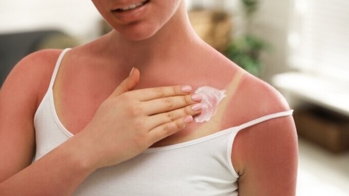 How to Treat Sunburn