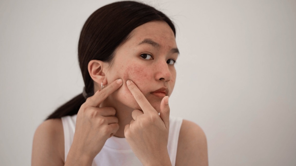 How to Remove Pimples Overnight at Home Naturally : Best Home Remedy for Acne