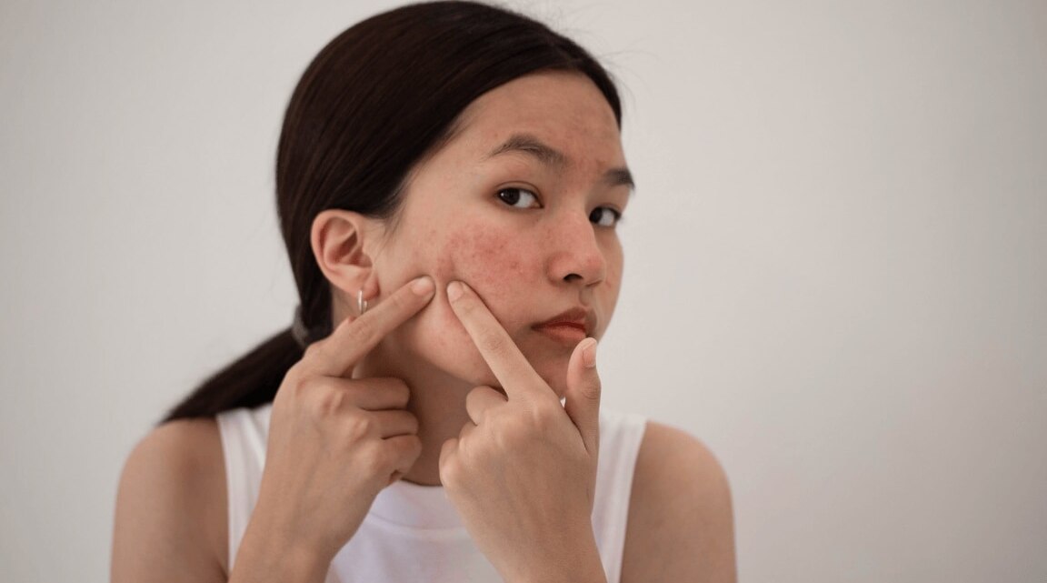 How to Remove Pimples Overnight at Home Naturally : Best Home Remedy for Acne