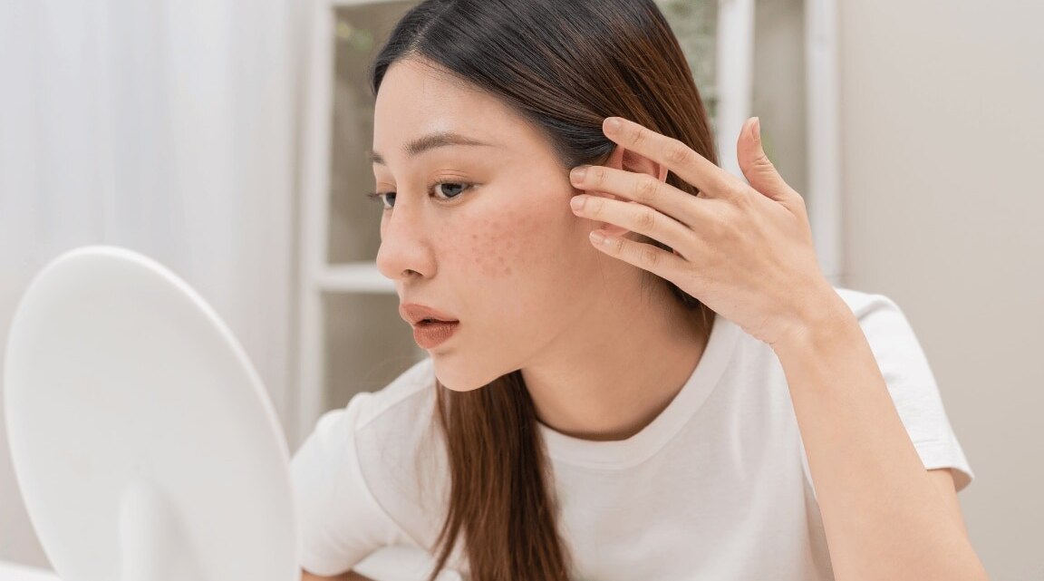 7 Skin-Safe Solutions For Melasma Treatment At Home