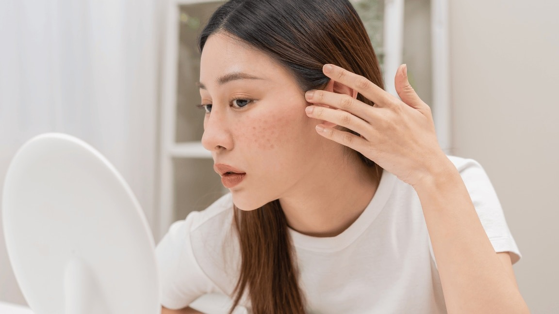 7 Skin-Safe Solutions For Melasma Treatment At Home