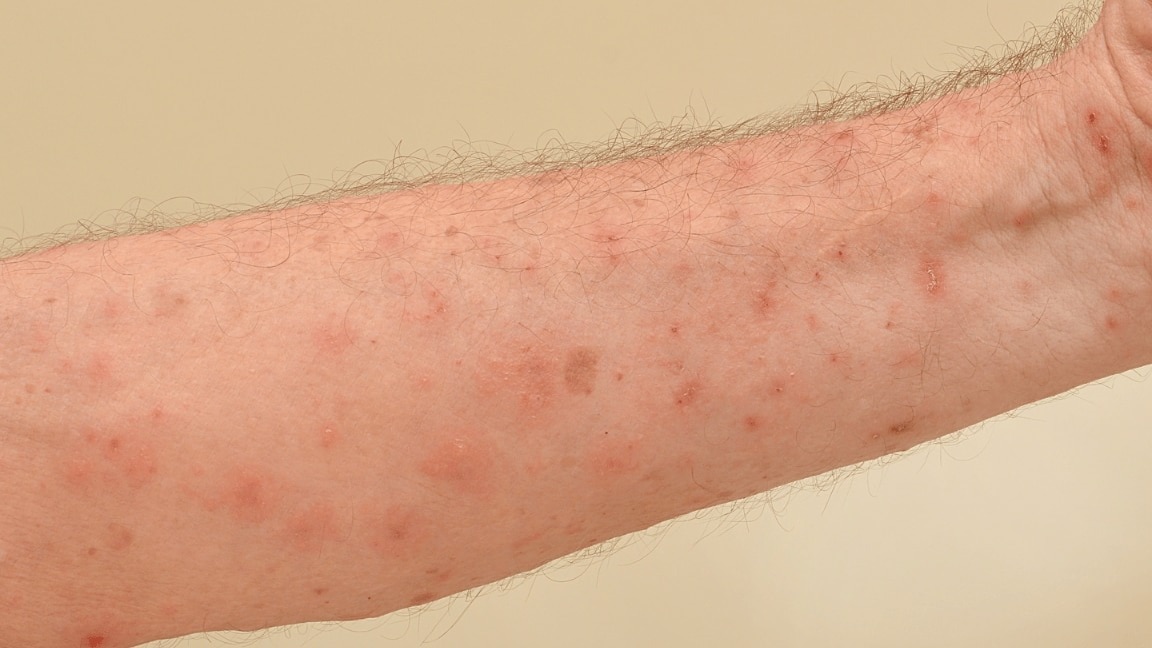 How to Get Rid of Arm Acne : Causes, Treatments, and Prevention Tips