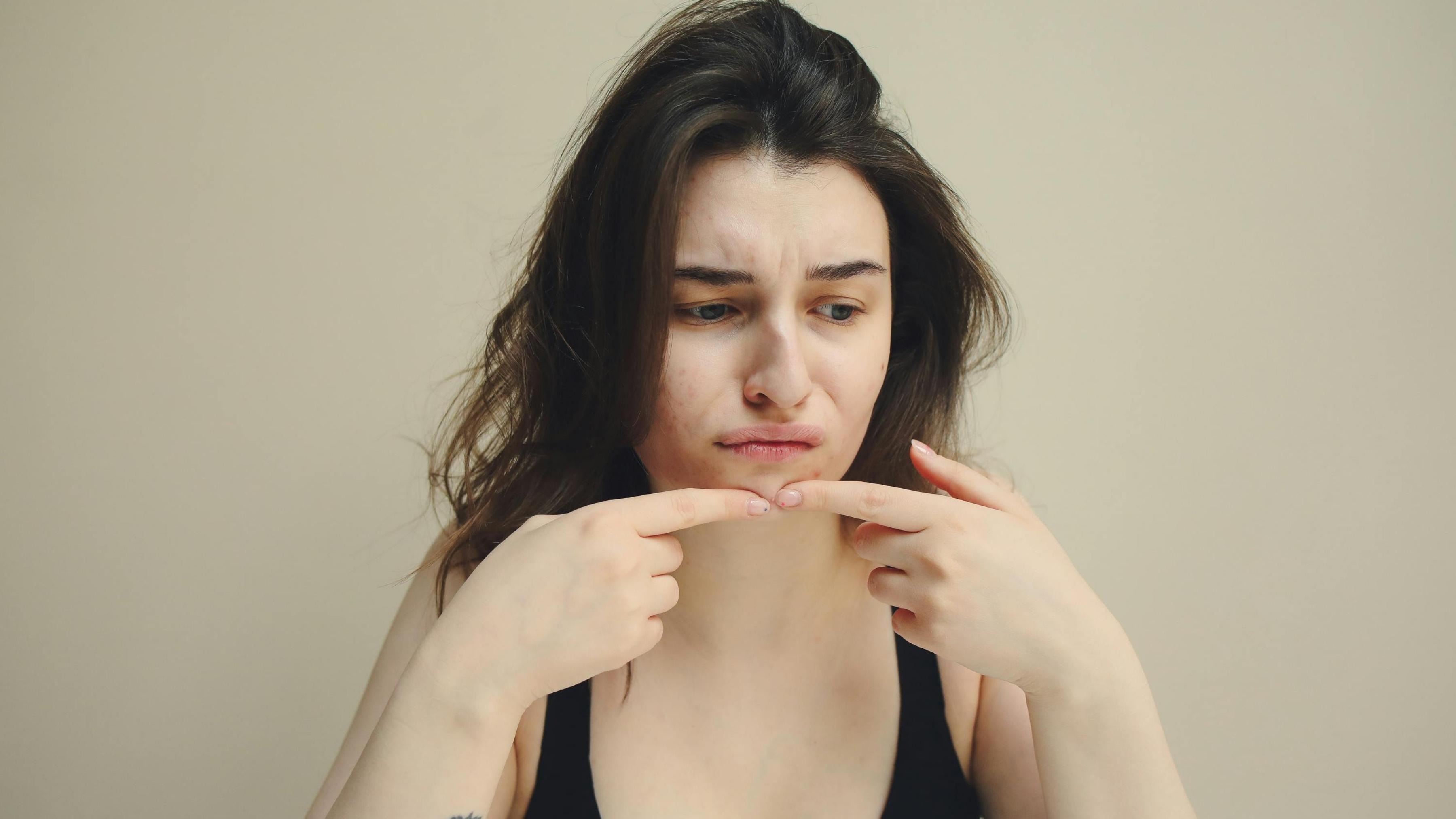 Causes of Pimple on face : Know the Different Types of Pimples and Treatment Tips