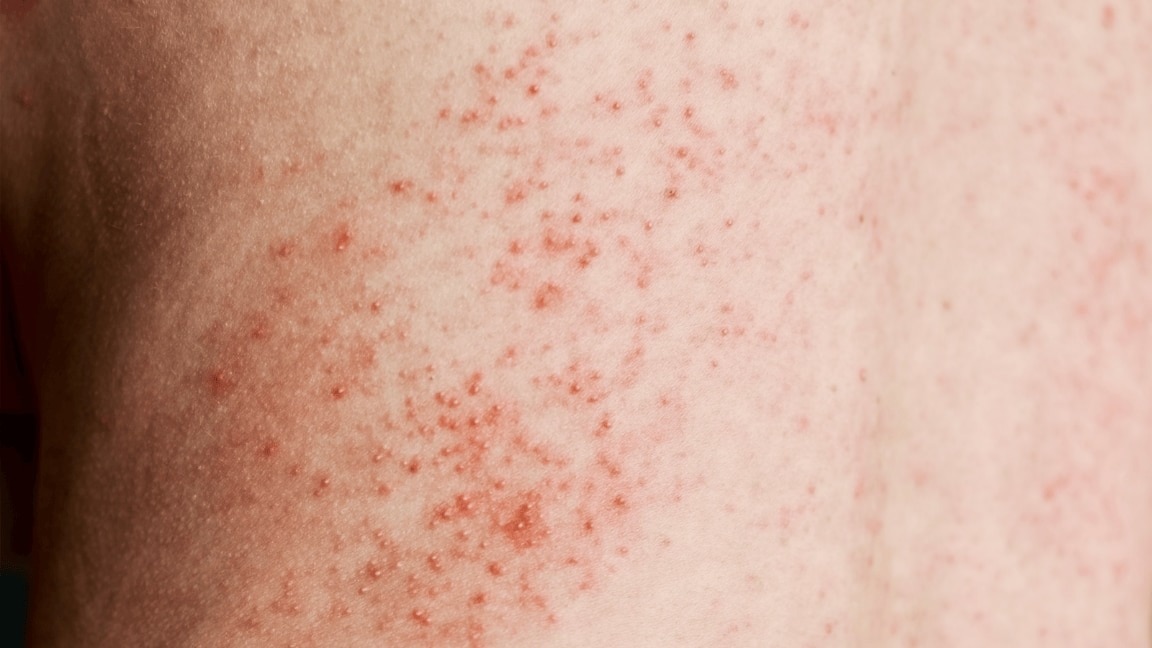 How To Remove Rashes Fast: Best Home Remedies for Soothing Itchy Skin