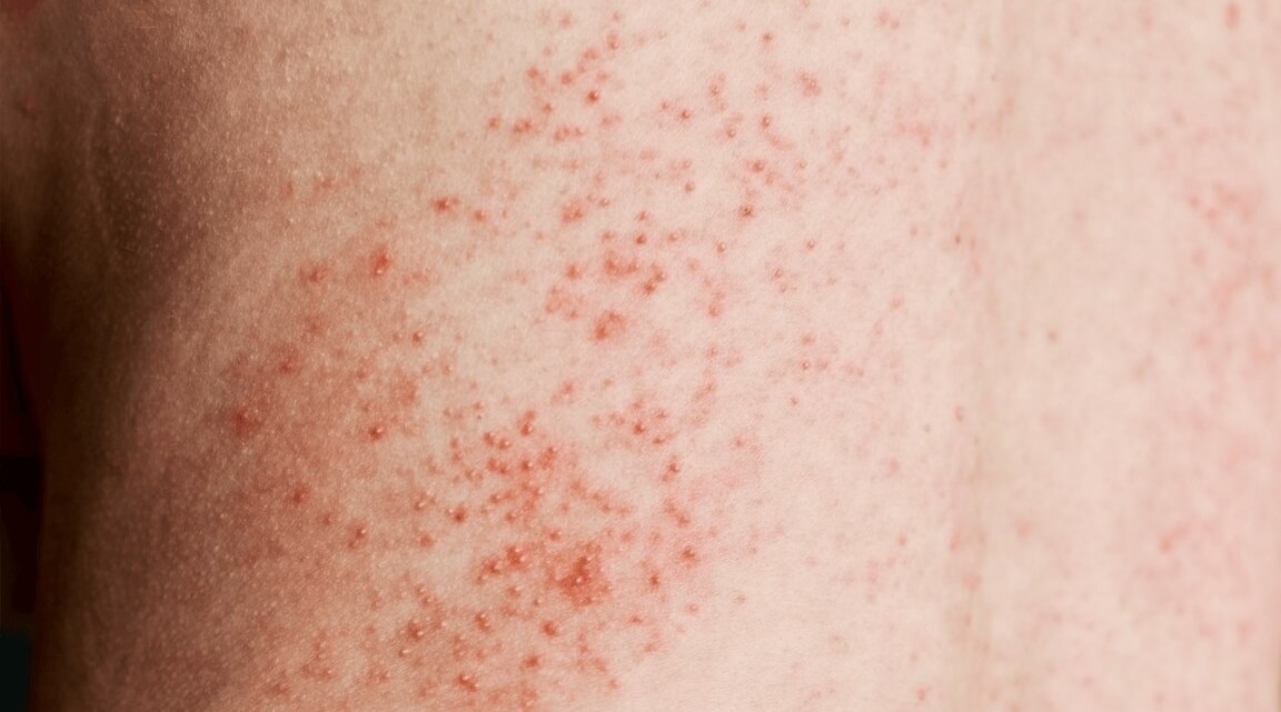 How To Remove Rashes Fast: Best Home Remedies for Soothing Itchy Skin