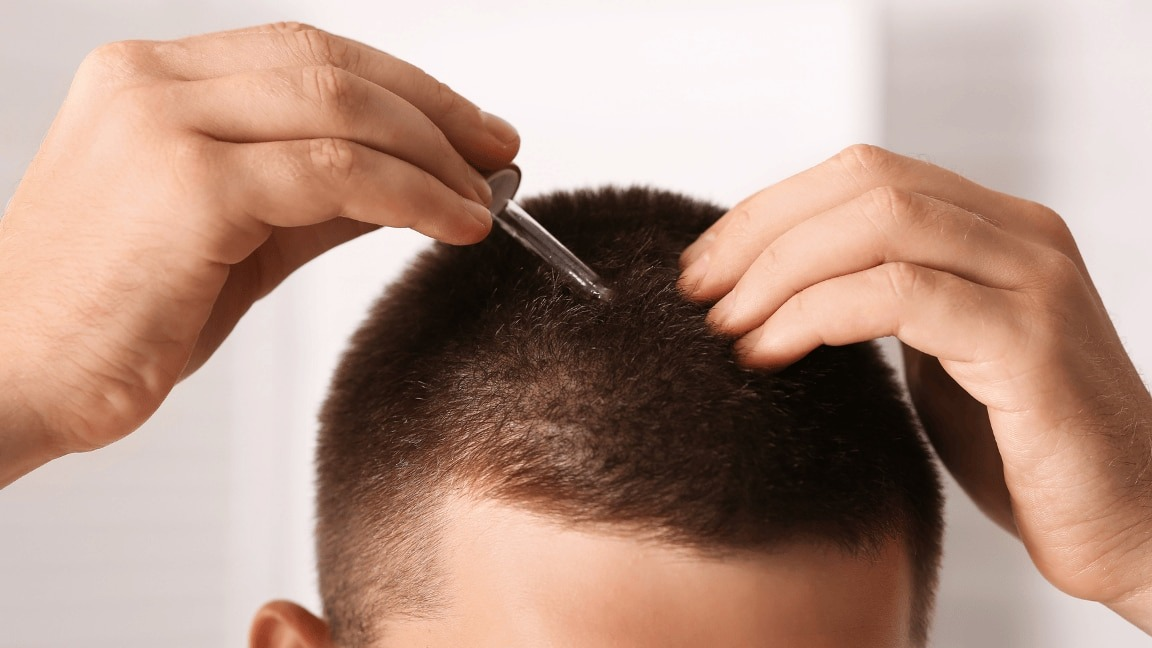 Hairline Growth Tips: How to Stop a Receding Hairline and Regrow Hair Naturally