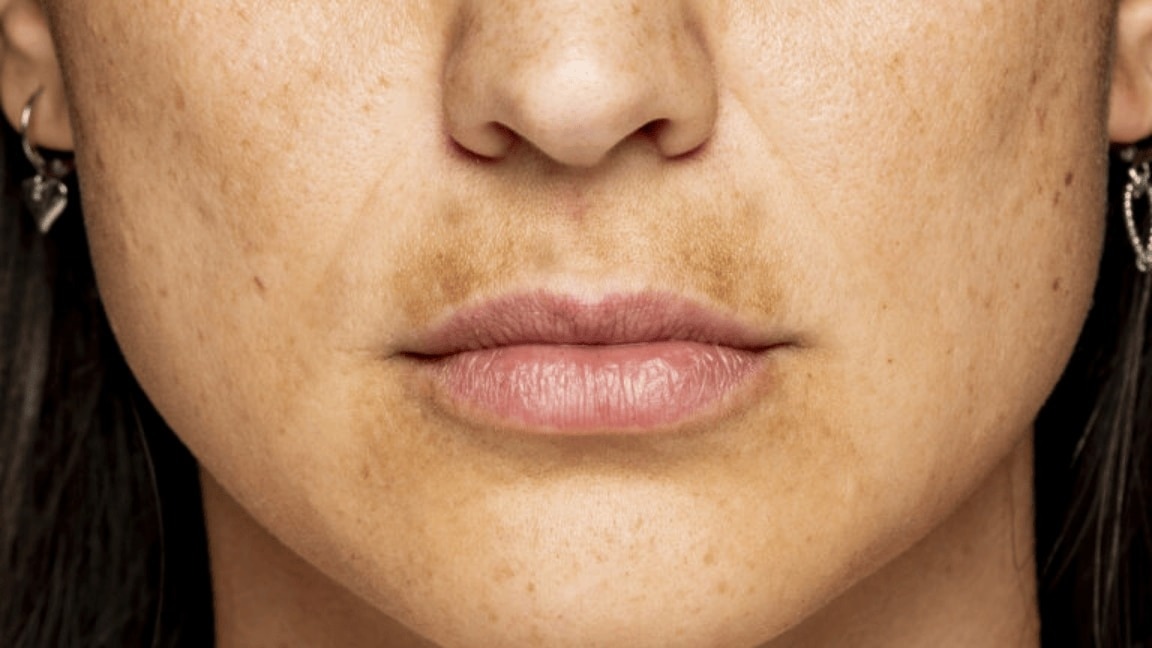 Hyperpigmentation Around Mouth: Causes and Treatments