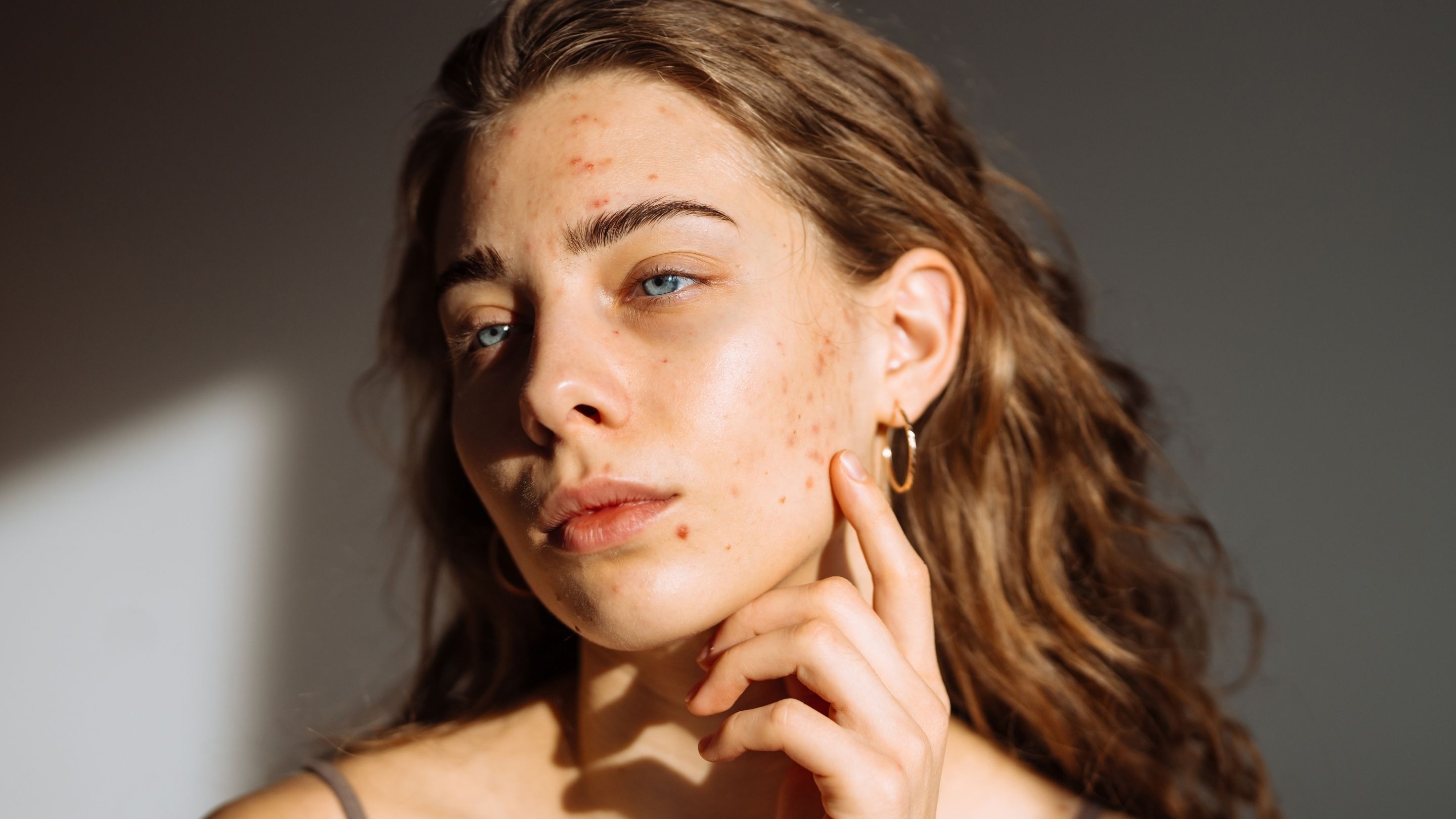 How to Remove Red Spots from Face Naturally : Best Proven Home Remedies