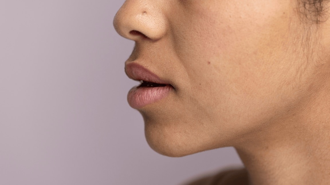 Hyperpigmentation on Chin : Causes, Treatments & How to get Rid off Dark Chin Naturally