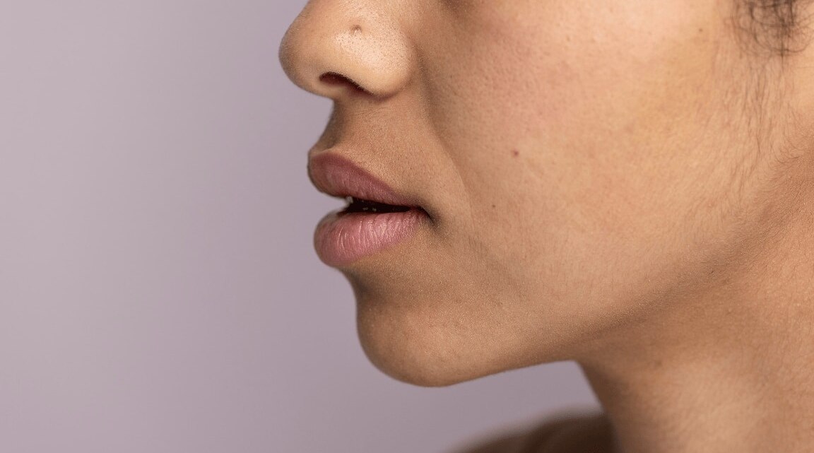 Hyperpigmentation on Chin : Causes, Treatments & How to get Rid off Dark Chin Naturally