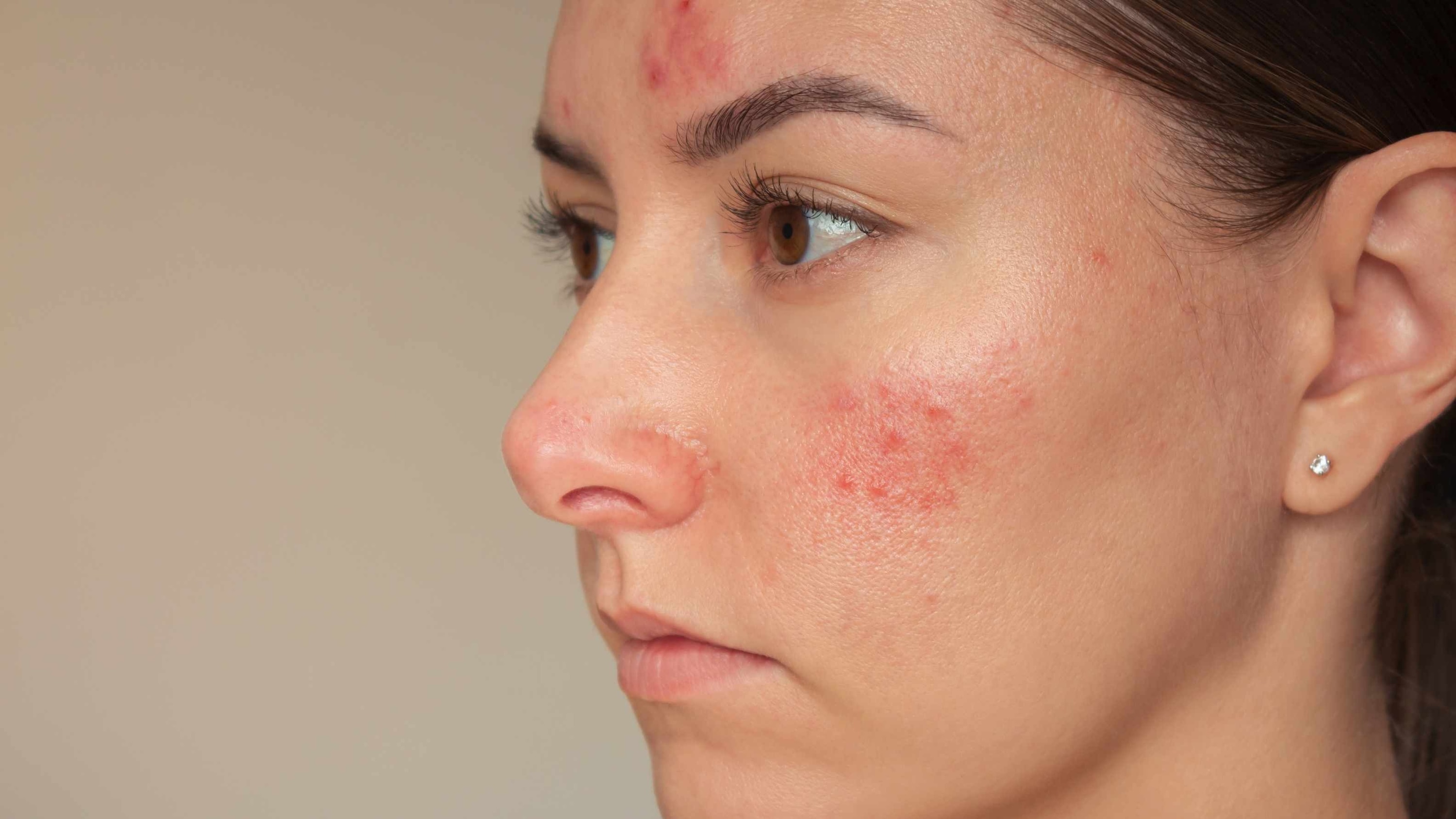 How to Treat Chemical Burn on Face from Skincare Products: Expert-Backed Guide