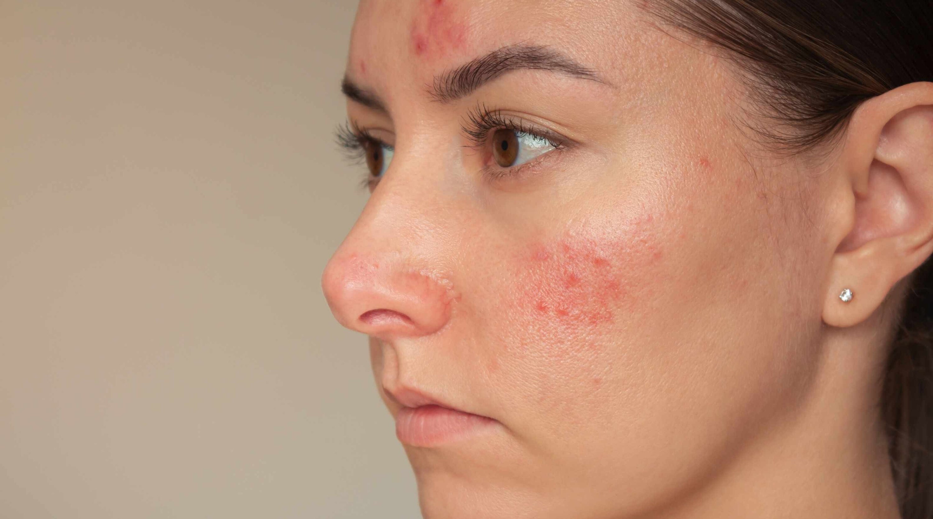 How to Treat Chemical Burn on Face from Skincare Products: Expert-Backed Guide