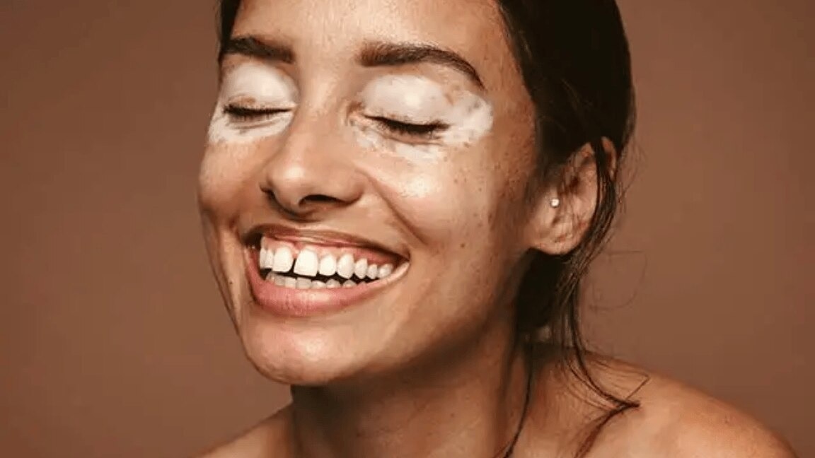 White Patches On Skin : Causes And Home Remedies