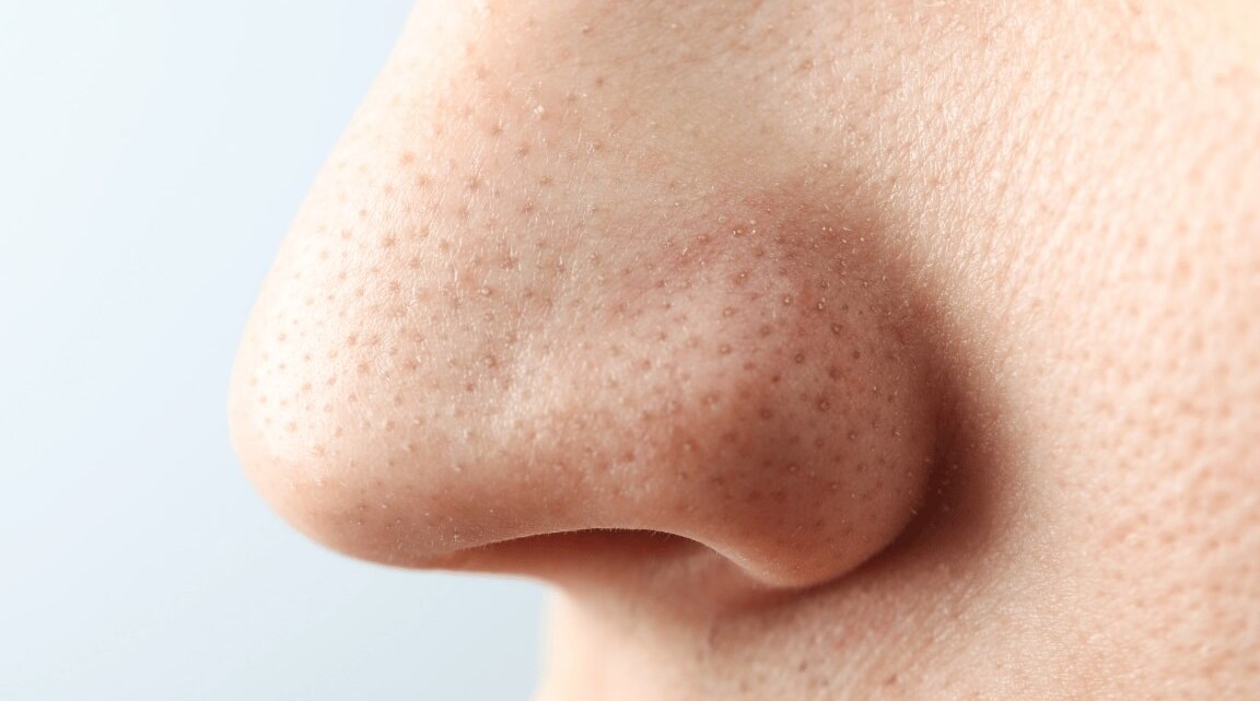Homemade Scrub for Blackheads : Natural & Effective DIY Remedy
