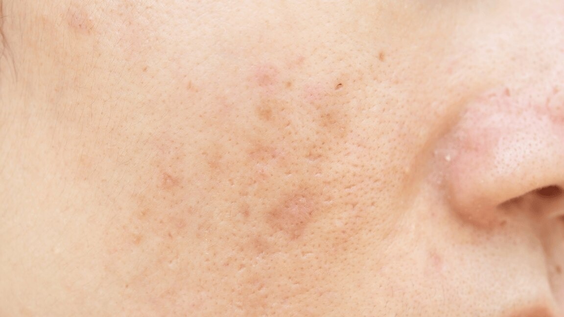 Remove Dark Spots Caused By Pimples: A Step-By-Step Guide