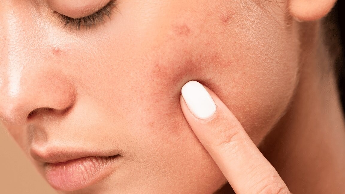 How To Remove Acne Scars Naturally: 7 Top Tips