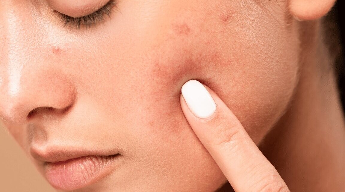 How To Remove Acne Scars Naturally: 7 Top Tips