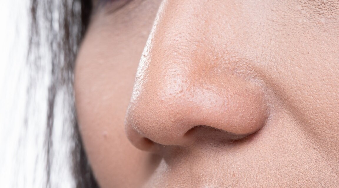 How to get Rid of Redness around the Nose