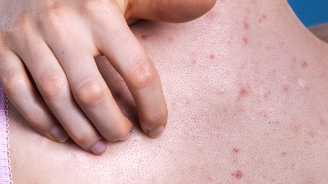 Avoid Picking or Scratching