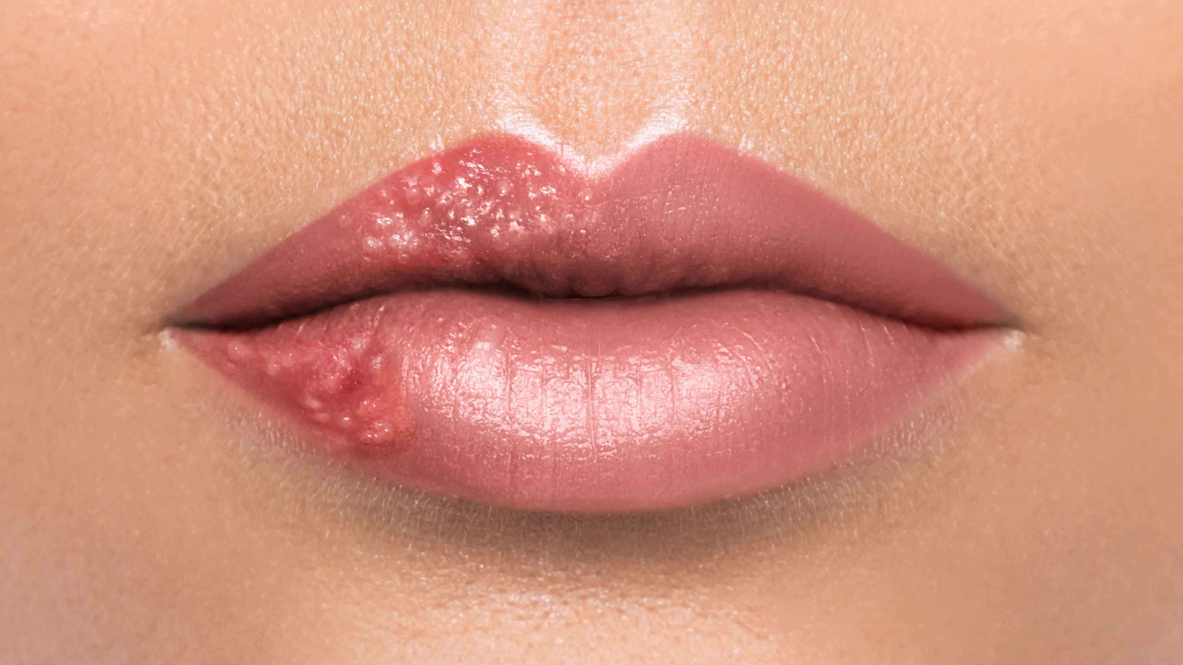 Difference between Lip Pimples and Cold Sores