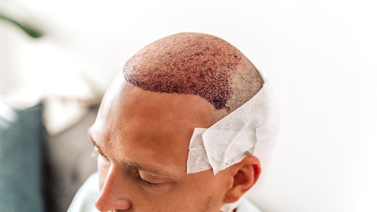 Hair Transplants A Great Solution, Not The Final Step