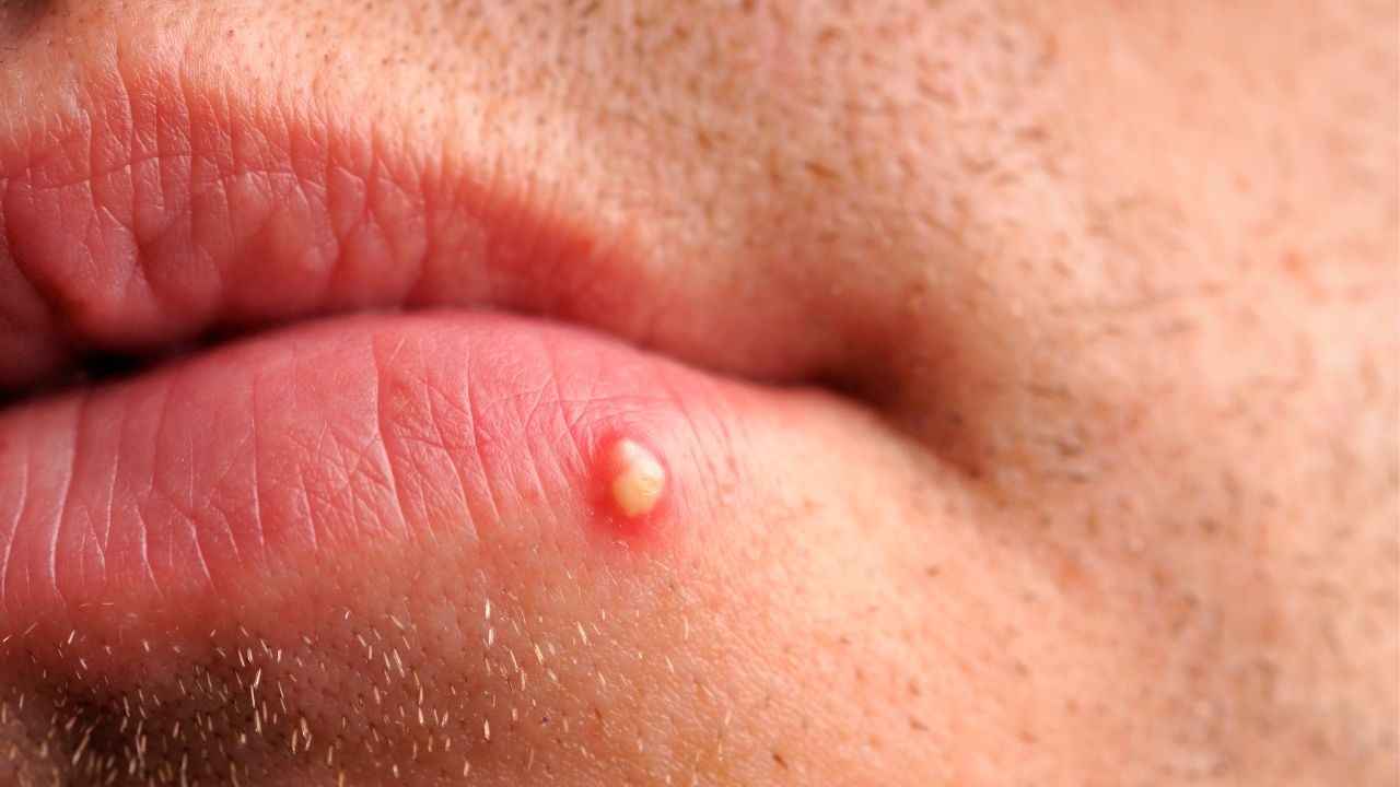Causes Pimples on the Lip