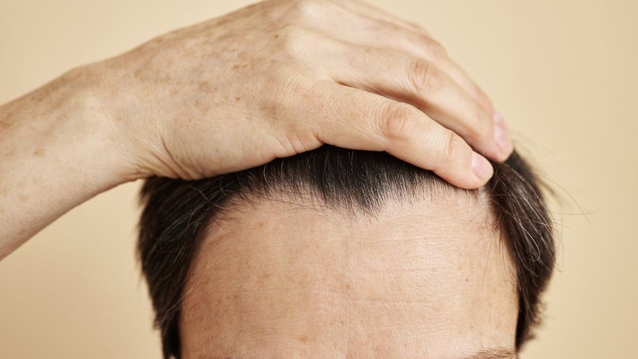 What is a Receding Hairline
