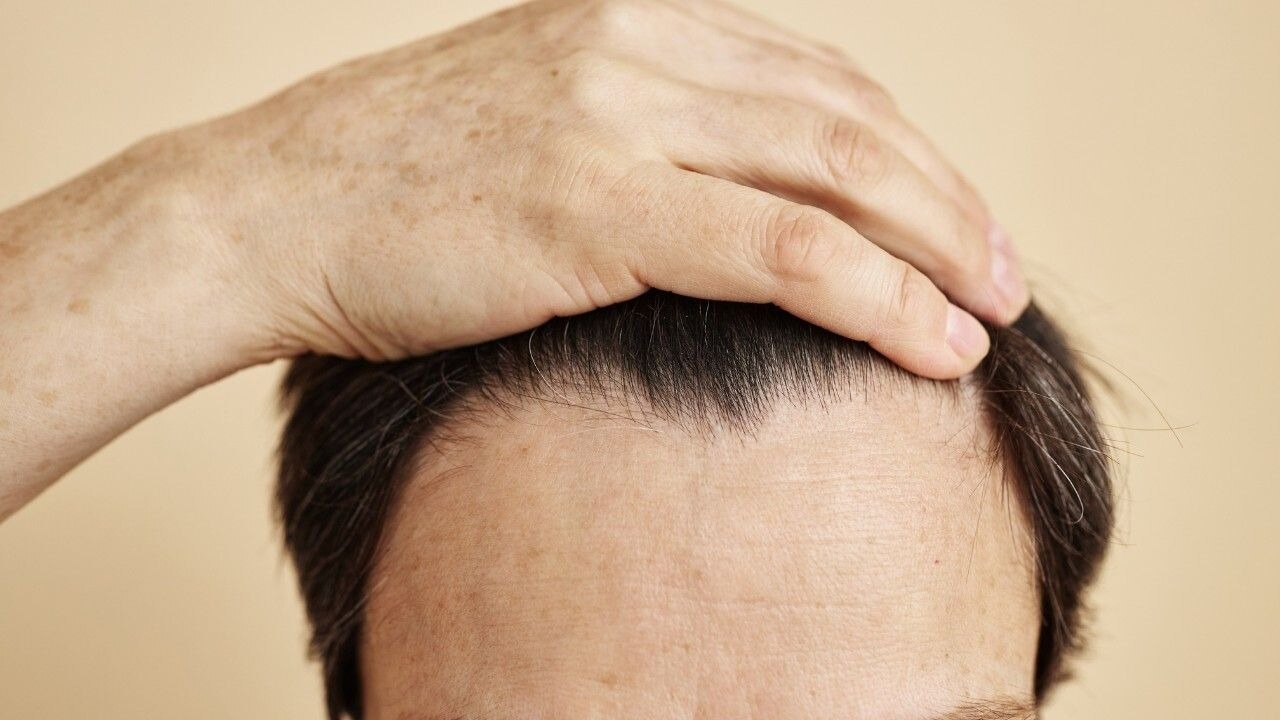 What is a Receding Hairline
