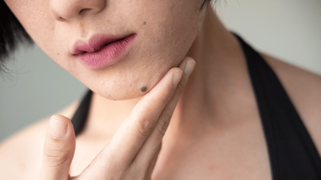 Types-of-facial-warts
