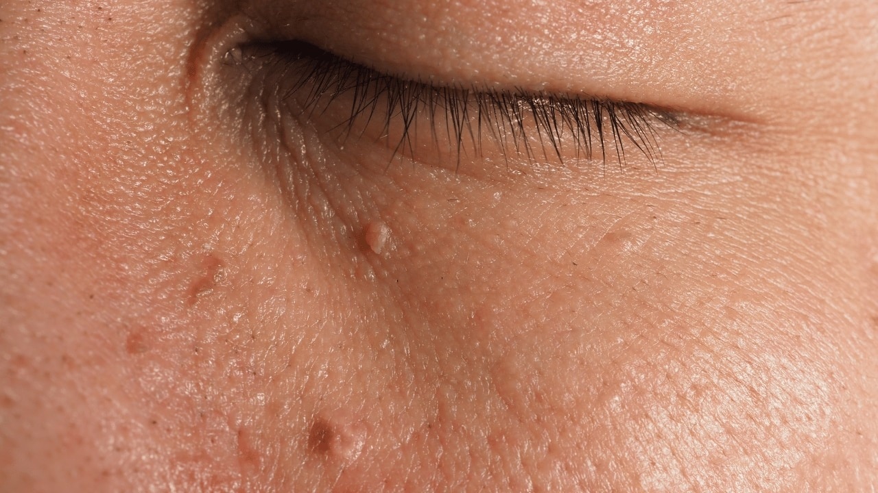 What-are-facial-warts