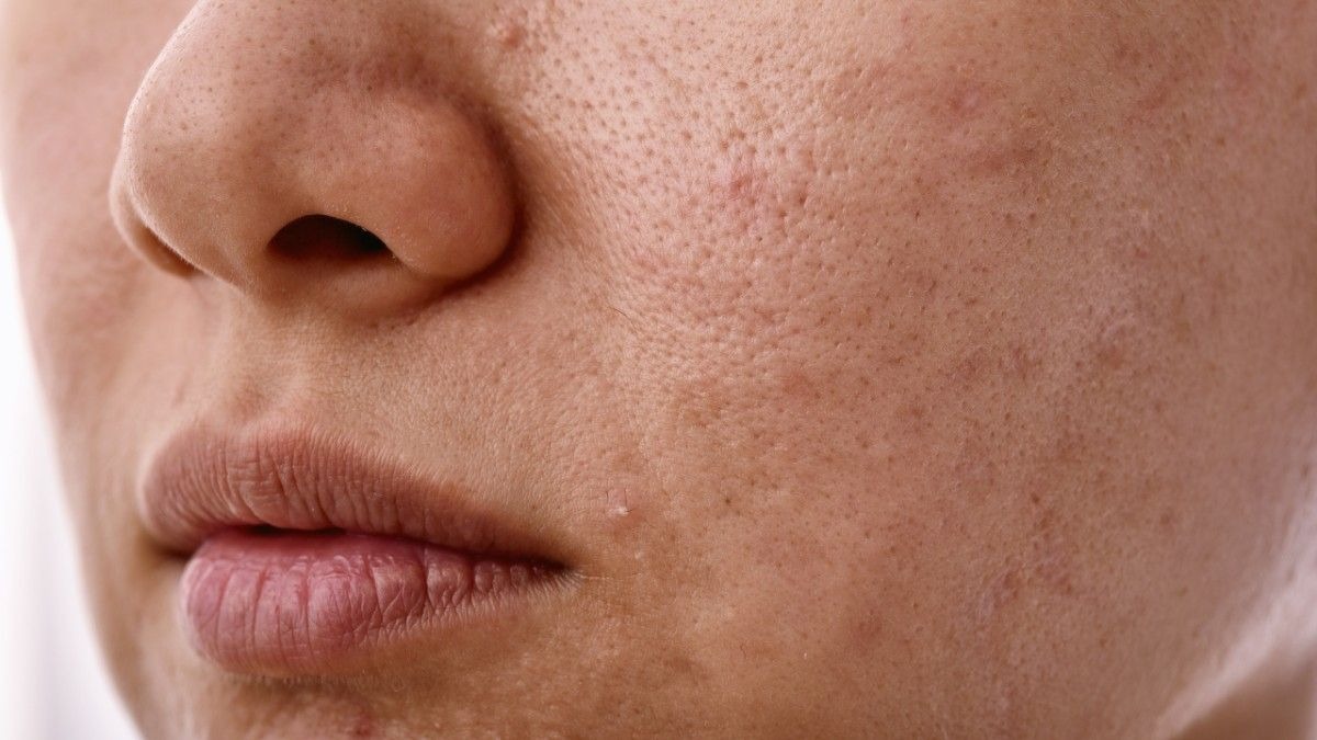 Improves Skin Tone and Texture