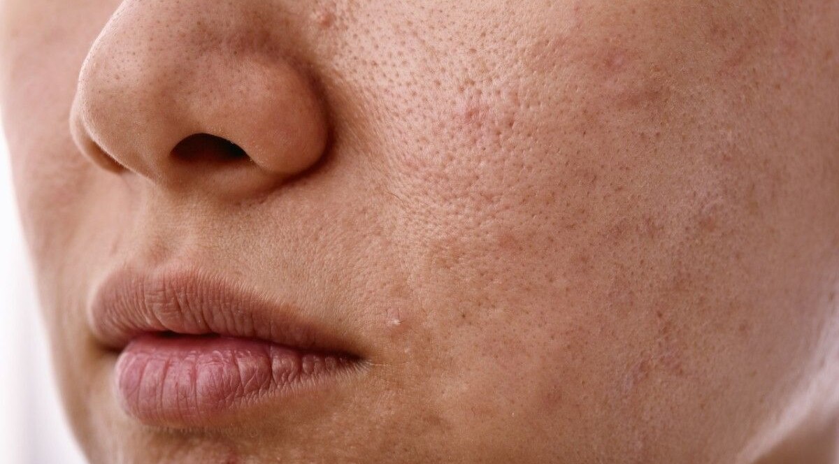 Improves Skin Tone and Texture