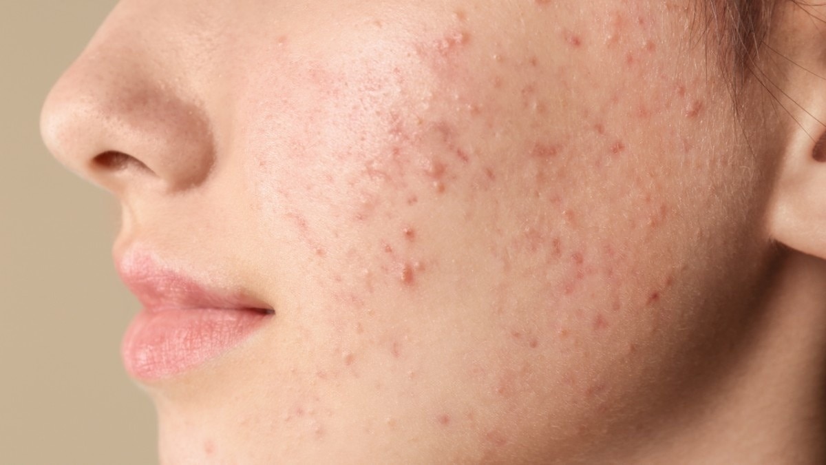 Oily & Acne-Prone Skin