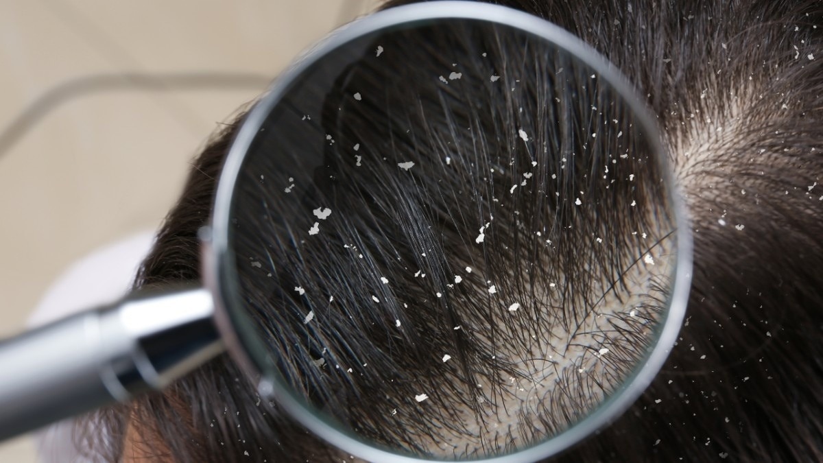 Reduces Dandruff &amp; Scalp Issues
