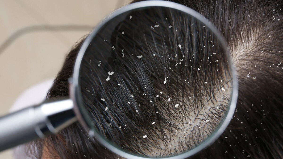 Reduces Dandruff &amp; Scalp Issues