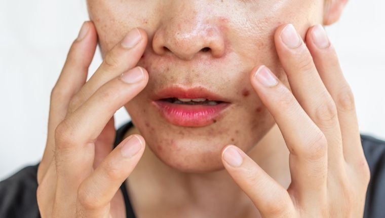 Benefits of Using Niacinamide